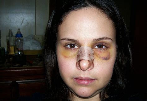 Узнайте, как безболезненно удалить опухоль на носу